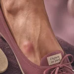 Oignon pied : bosse près du gros orteil et gêne au chaussage